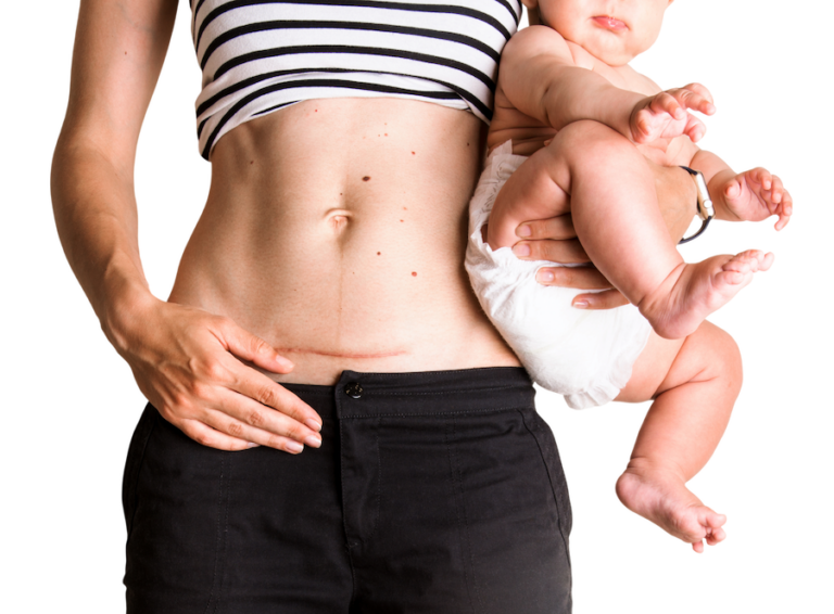 Postpartum surgery